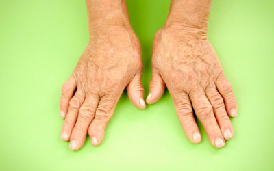 Ayurveda Treatment For Arthritis