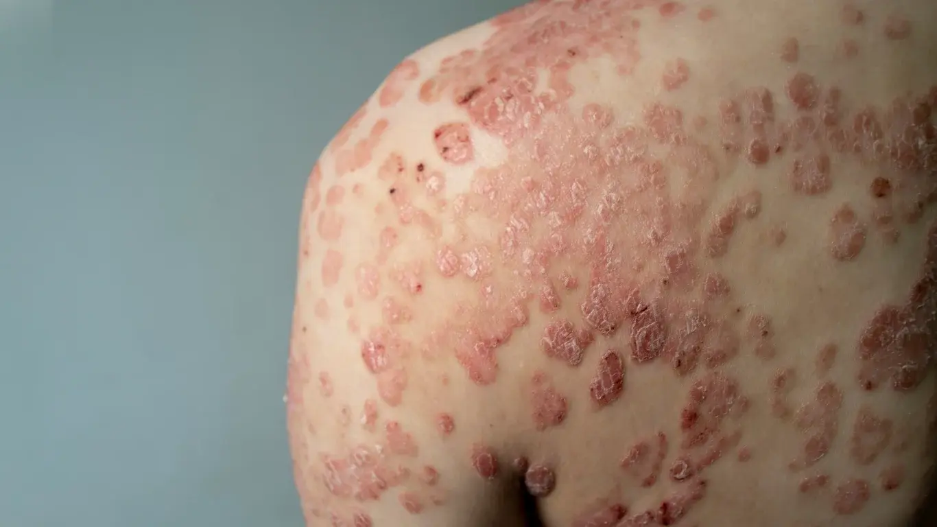 Psoriasis ayurvedic treatment Psoriasis ayurvedic treatment