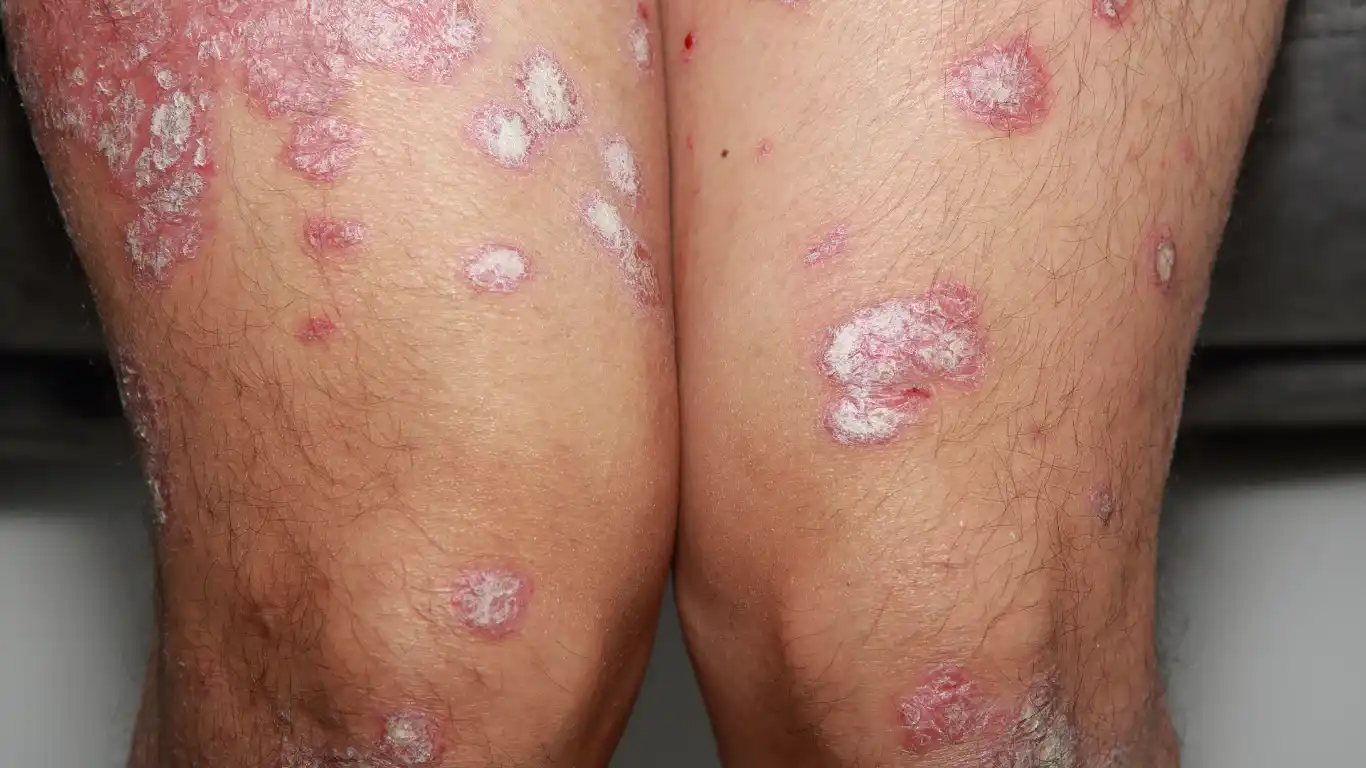 Pustular Psoriasis