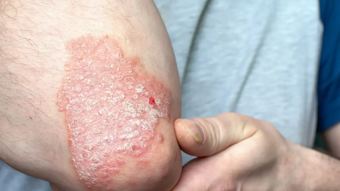 Inverse Psoriasis