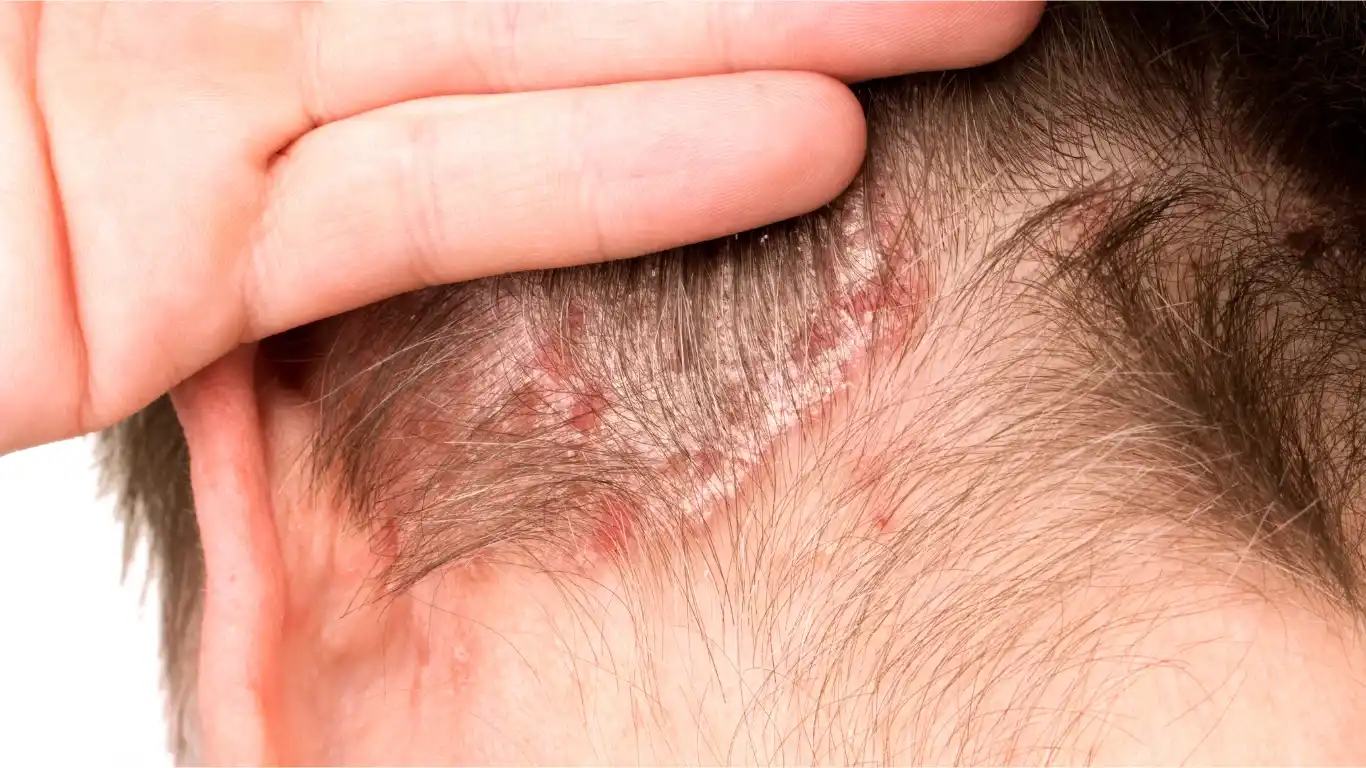 Plaque Psoriasis
