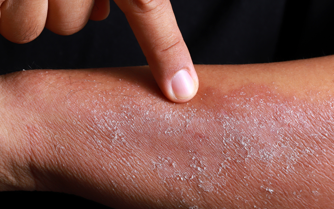 What is Eczema and How Ayurveda Explains this Skin Disease