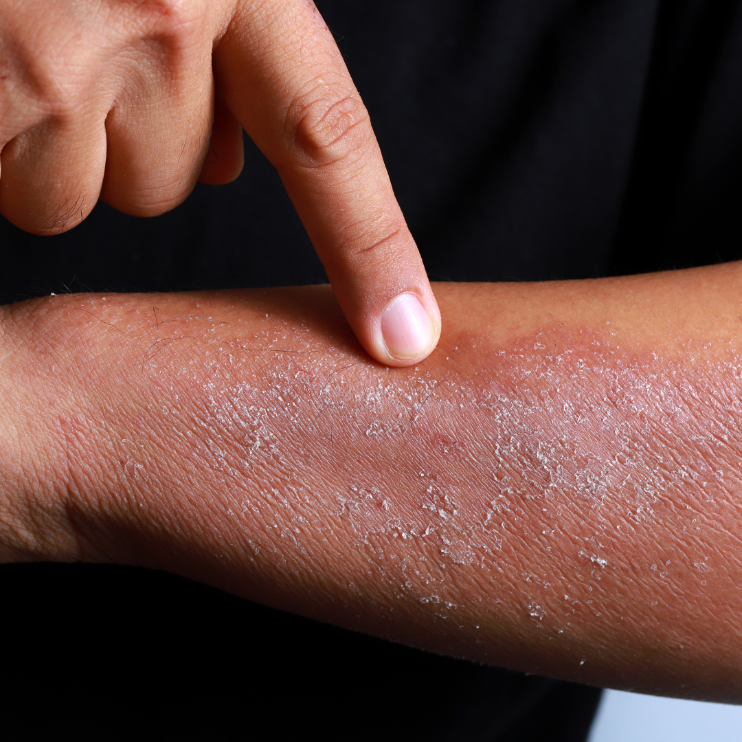 Close-up of a person’s arm with dry, scaly, and inflamed skin — showing symptoms of eczema disease treated naturally through Ayurvedic healing.