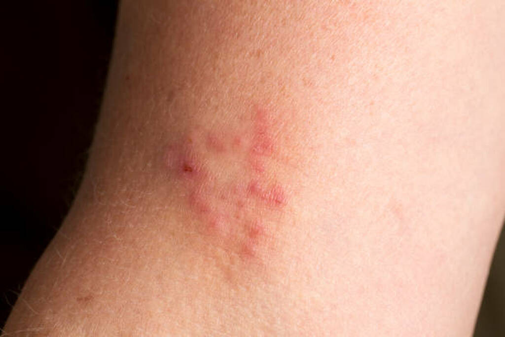 Close-up of a skin infection showing ringworm symptoms, used to illustrate Ayurvedic treatment approaches for ringworm at Dheemahi Ayurvedic Centre.