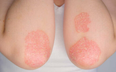 How to treat psoriasis with ayurveda ?