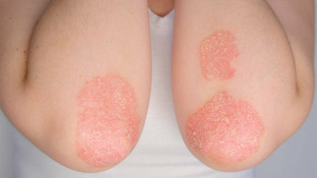 How to treat psoriasis with ayurveda ?