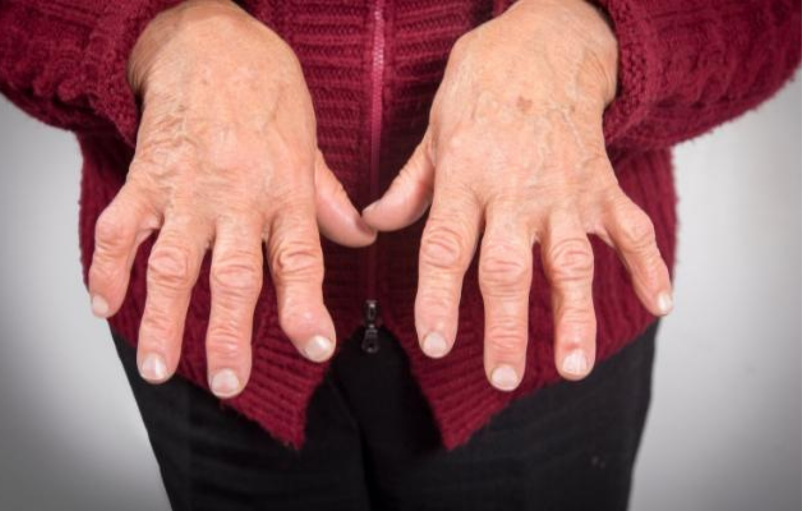 Elderly woman's hands showing swollen joints — Joint Pain Ayurveda treatment focus